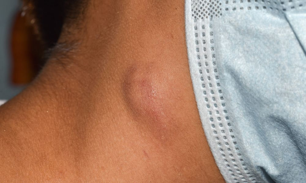  Zväčšená lymfatická uzlina na krku – príznak infekcie alebo zápalu, lokalizované lymfatické uzliny na krku sú častým miestom opuchu pri vírusových alebo bakteriálnych ochoreniach.