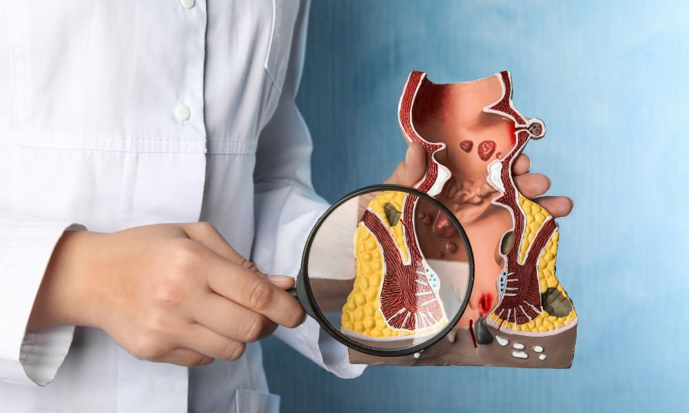  Lekár drží anatomický model konečníka a hrubého čreva s lupou zvýrazňujúcou patologické zmeny, čo ilustruje význam kolonoskopie pri diagnostike hemoroidov, polypov a ochorení čriev.