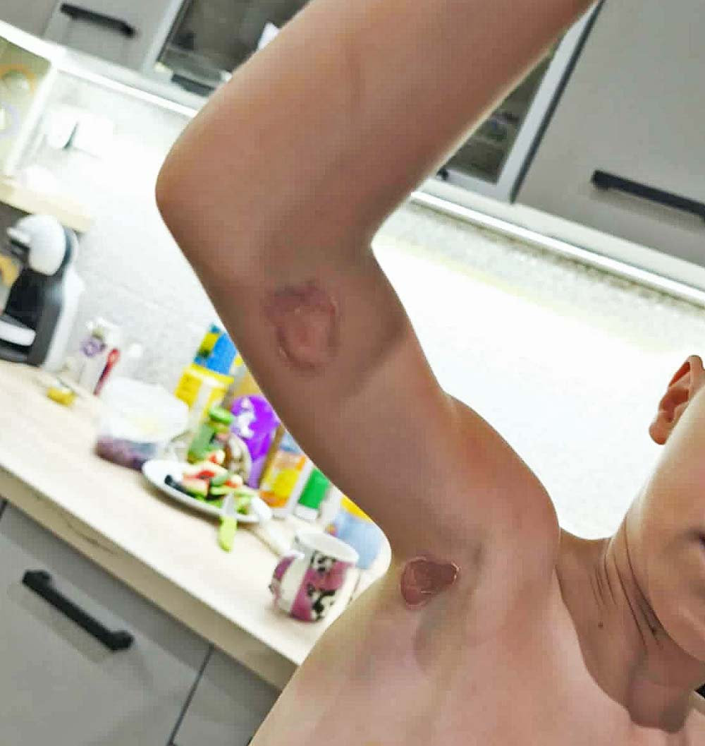  Druhá a tretia fáza ochorenia impetigo