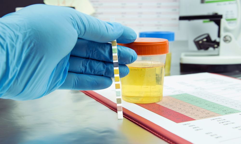  Test na krv v moči – Lekár drží testovací prúžok na krv v moči vedľa vzorky moču v laboratóriu