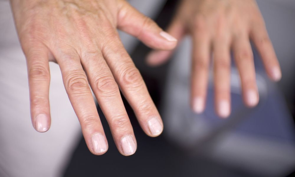  Zápalové prejavy na prstoch rúk ako možné varovné príznaky lupus v neskorších štádiách.