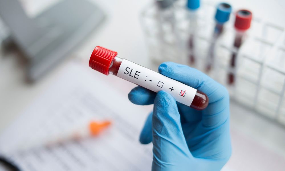  Krvná skúmavka označená skratkou SLE – čo je lupus a ako sa diagnostikuje pomocou krvných testov.
