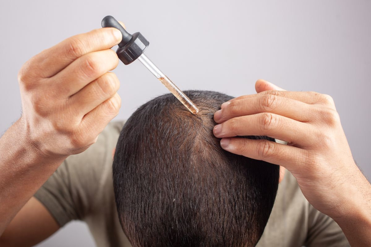  muž aplikujúci minoxidil na vlasy