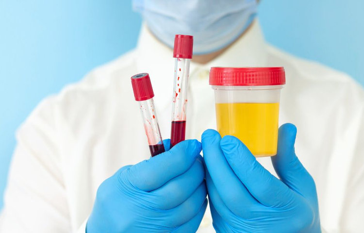 Krv v moči a vyšetrenie – Lekár drží skúmavky s krvou a vzorku moču na laboratórne testy