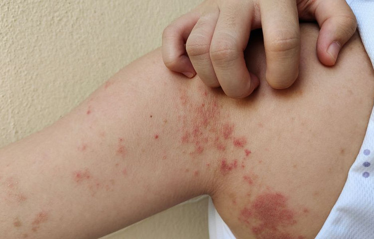 Impetigo u detí aj dospelých. Ako vyzerá a ako ho liečiť?