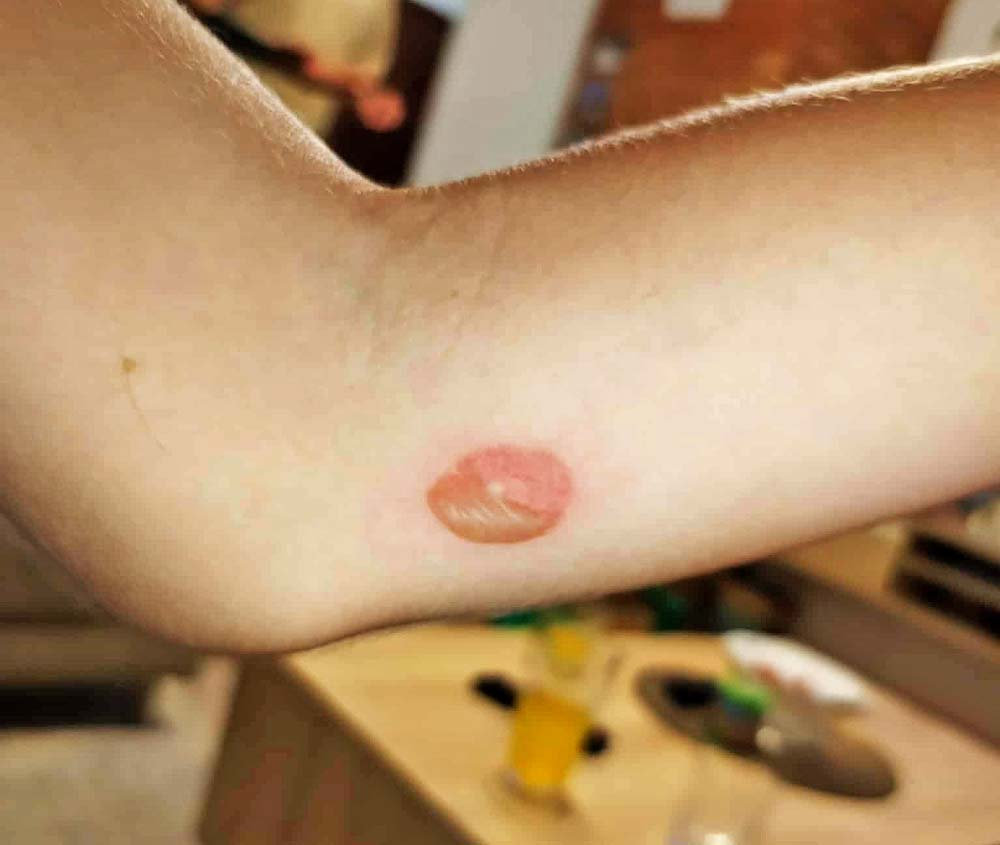  Prvá fáza impetika - malé červené škvrnky či pupienky