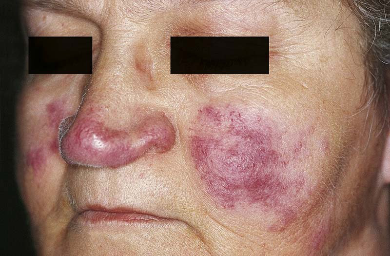  Sčervenanie na tvári v tvare motýľa ako typický prejav ochorenia systemový lupus.