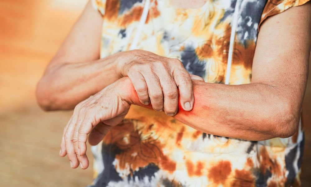  Varovné príznaky lupus zahŕňajú aj zápaly a bolesti kĺbov alebo svrbenie pokožky.